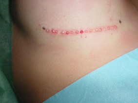foto cicatrice seno dopo Mosaic Surgery