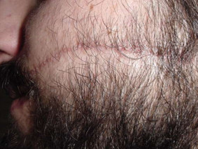 foto cicatrice viso dopo una seduta di Mosaic Surgery