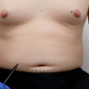 liposuzione cicatrice